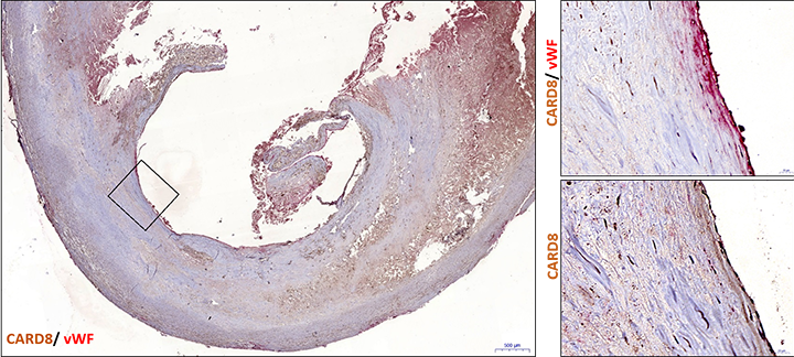 Figure1. Expression of CARD8 staining (brown / DAB) in endothelial cells (Red) of human carotid atherosclerotic plaque.