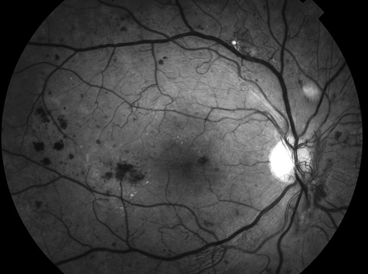 Ögonbottenfotografi av höger öga med synhotande mikrovaskulära förändringar, s.k. proliferativ diabetesretinopati.